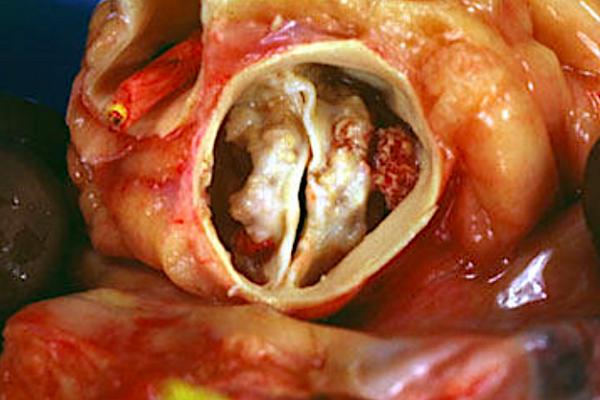 TAVR Shows Favorable Safety in Patients with Bicuspid